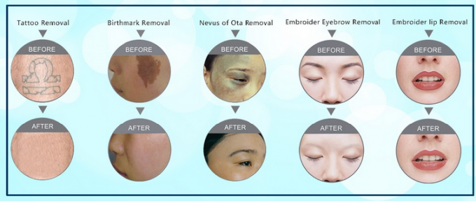 aprovação do ISO da máquina 1000mj da remoção do laser da cicatriz/tatuagem da acne de 1064nm 532nm